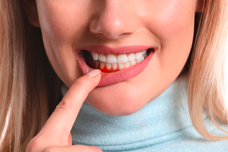 Bild Frau mit Zahnfleischbluten